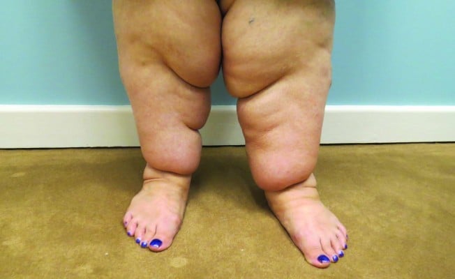 Understanding Comorbidities Associated with Lipedema: Beyond the Swelling –  Legs Like Mine