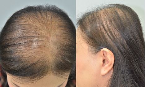 Female Pattern Hair Loss: Frequently Asked Questions