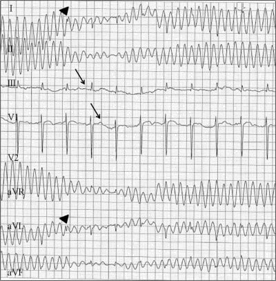 sinus tachycardia with artifact meaning
