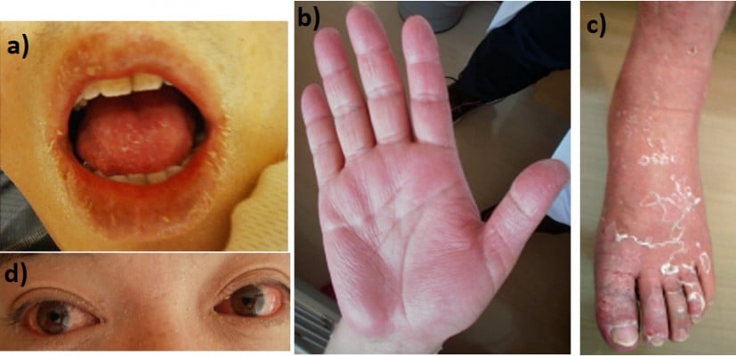 Gooey taxa Tyr Adult-onset Kawasaki disease (mucocutaneous lymph node syndrome) and c |  IMCRJ