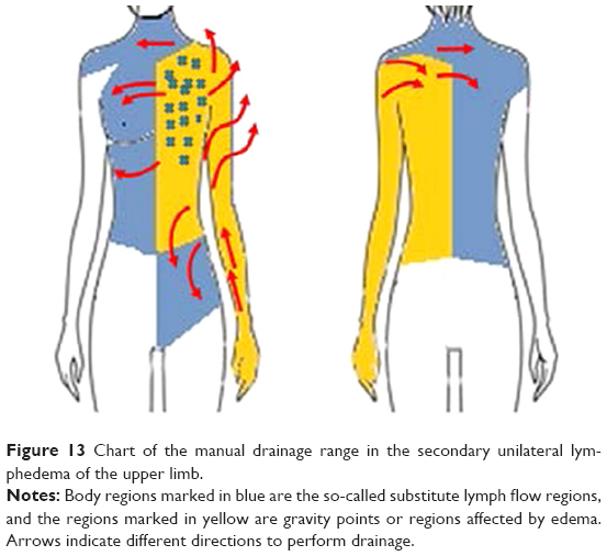 Are compression corsets beneficial for the treatment of breast