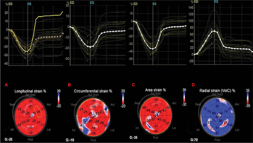 Longitudinal strain by speckle tracking and echocardiographic