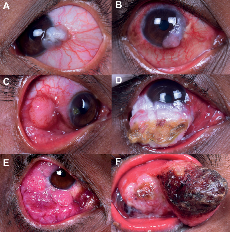 conjunctival squamous cell carcinoma