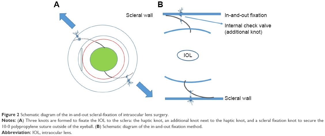 A) Sutured scleral fixated (SF) IOL, (B) SF IOL showing iris shaffing