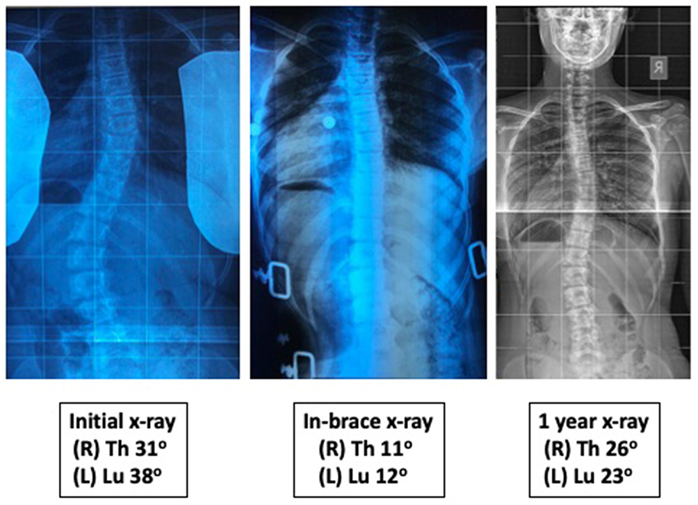 Boston Brace (PDF) - Scoliosis Research Society