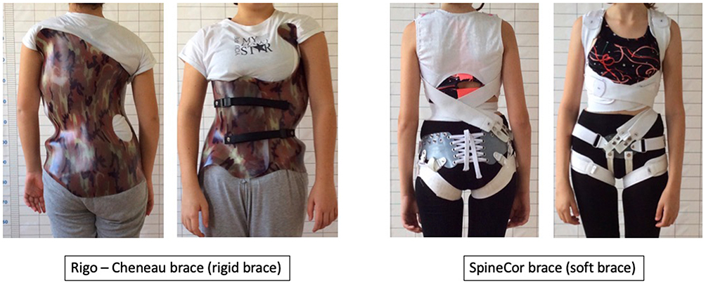 Frontiers  Immediate Outcomes and Benefits of 3D Printed Braces for the  Treatment of Adolescent Idiopathic Scoliosis