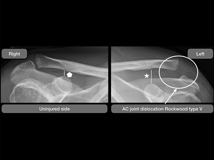 Optimal Management of Acromioclavicular Dislocation: Current Perspecti