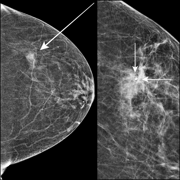 Locating Biopsy Marker Clips on Breast MRI: What a New Study Reveals