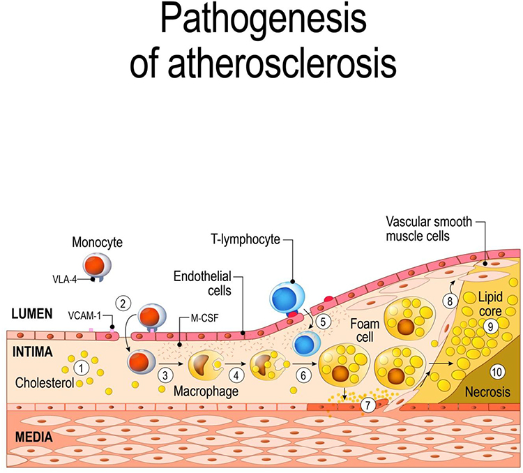 atherosclerosis pathophysiology