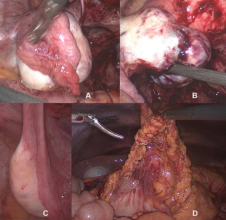 a Picture of an ovarian seromucinous borderline tumour. The