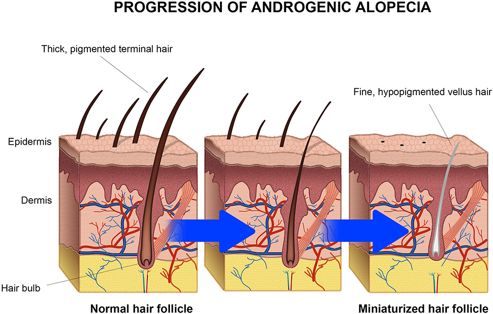 scarring alopecia histology