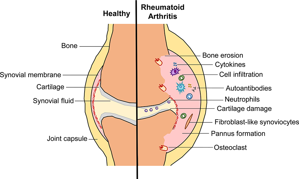 pathophysiology of rheumatoid arthritis diagram