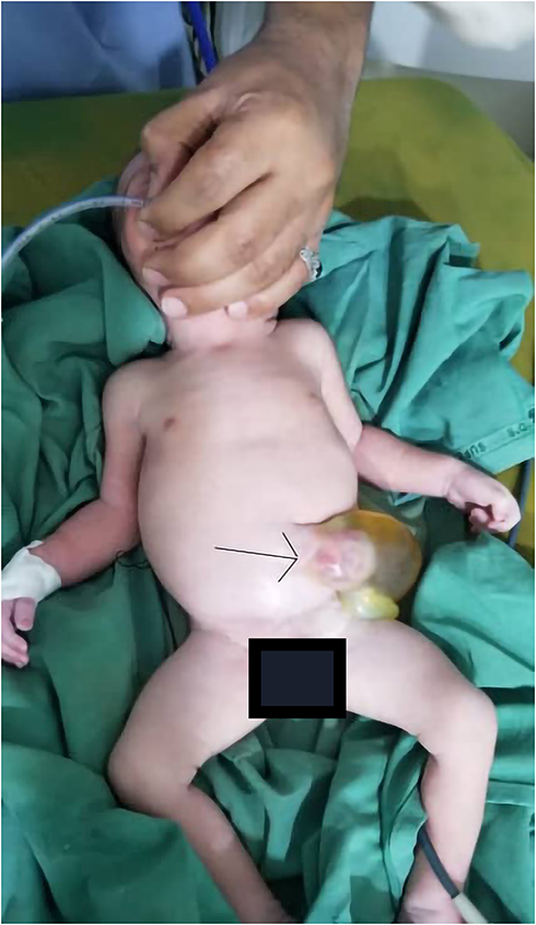 Kids Pelvic Surgery - Umbilical Hernia (Belly button hernia or naaf ka  hernia) is a commonly seen condition in newborn babies. Its causes,  symptoms, presentation, treatment, and surgery is being explained here.