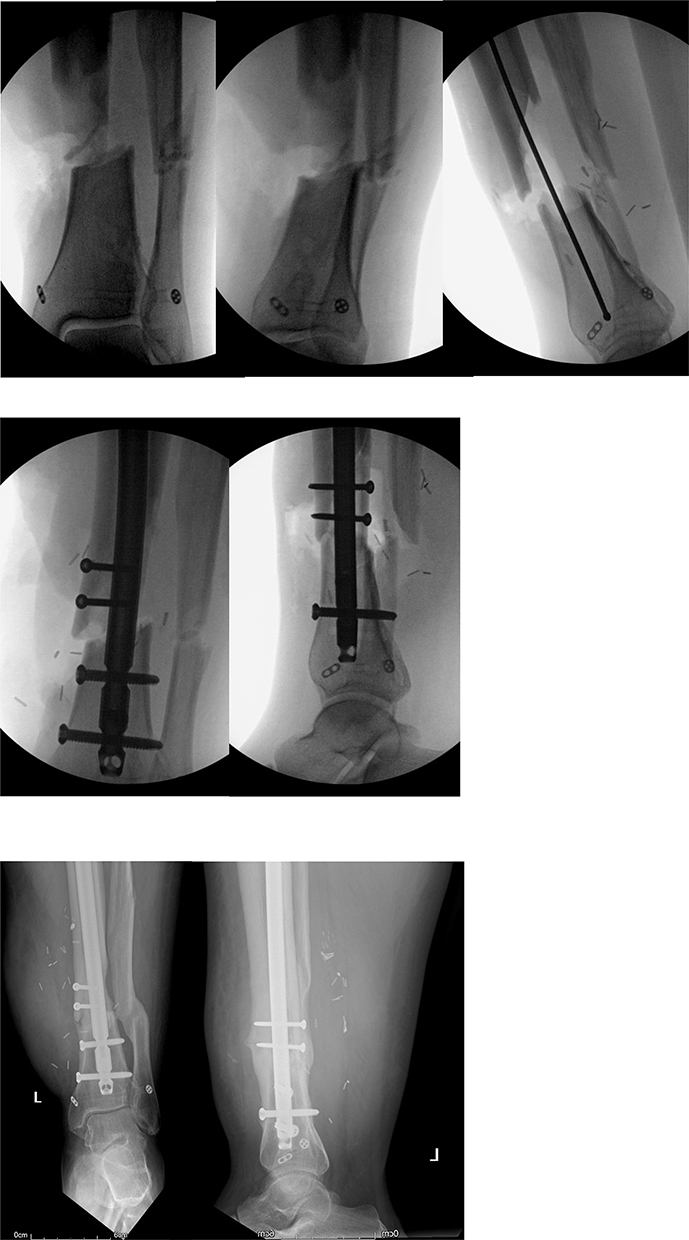 Ilizarov method of fixation for the management of pilon and distal tibial  fractures in the compromised diabetic patient: A technique guide.