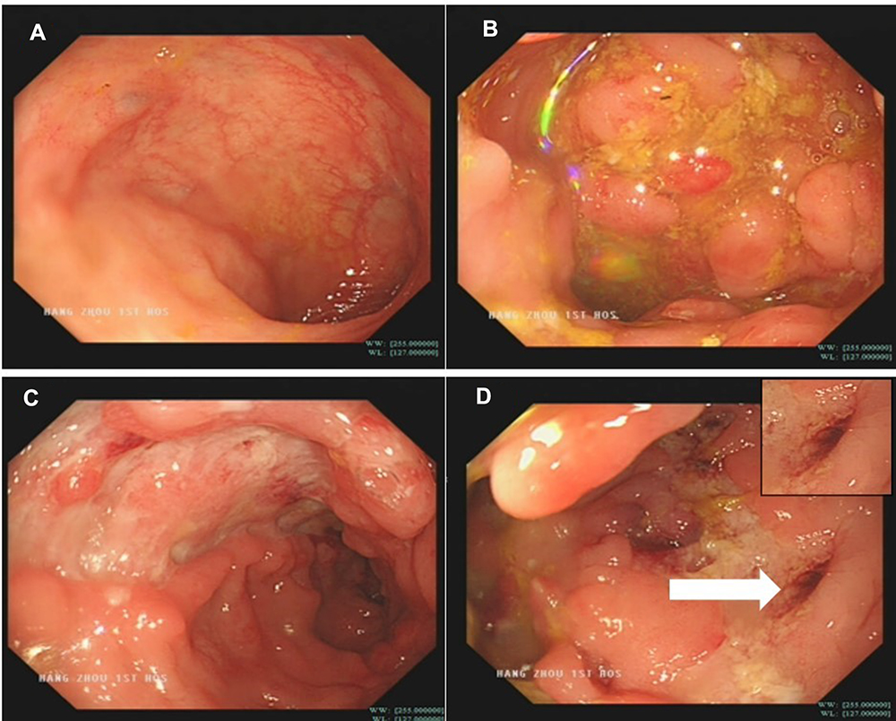 intestinal fistula crohns disease