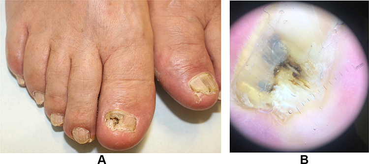 Perspectives on the diagnosis & management of onychomycosis