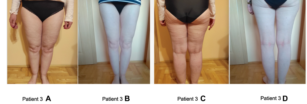 Taking a Stand Against Lipedema: Life After MLE - Total Lipedema Care