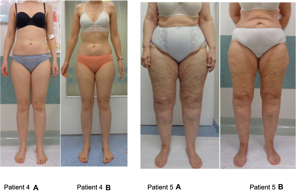 Lipedema Can Be Treated Non-Surgically: A Report of 5 Cases – Vascular