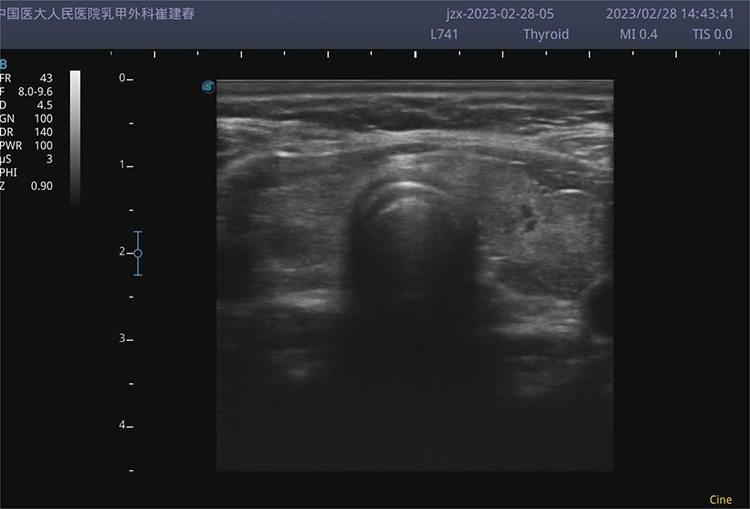 subacute thyroiditis ultrasound
