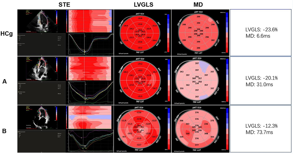 Changes in left ventricular global and regional longitudinal stra