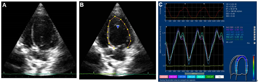 Three-dimensional Speckle Tracking Echocardiography in Light Chain